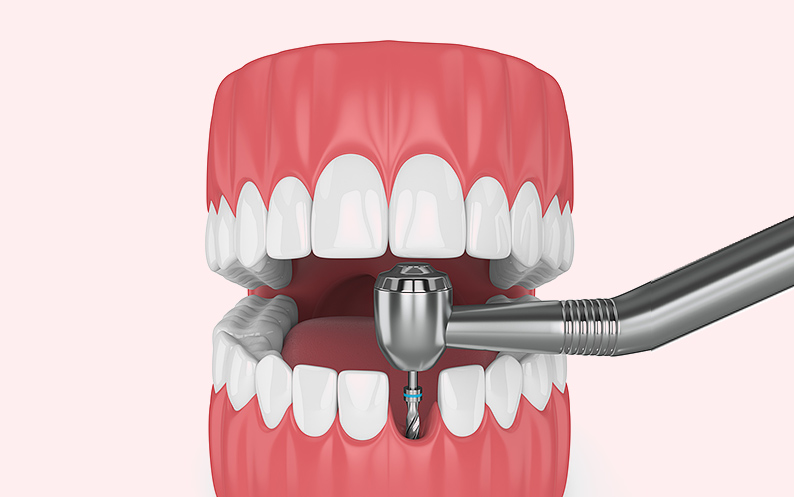 denture implants nyc
