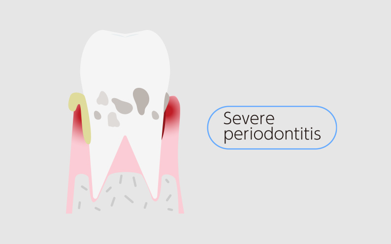 severe periodontitis treatment