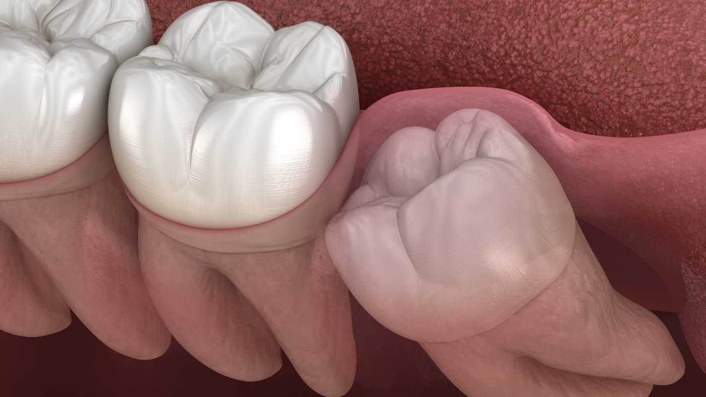 Impacted Wisdom Teeth: Signs and Symptoms