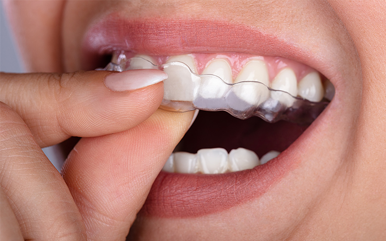 Mouth Guard mouth guard for grinding teeth NYC