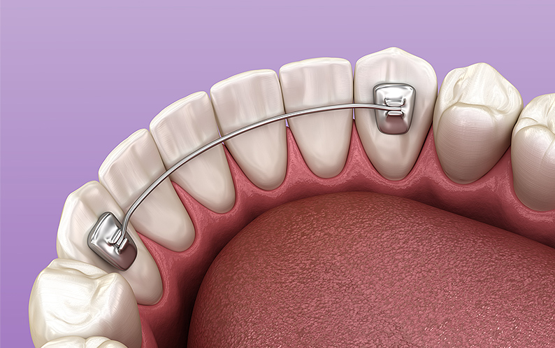 Permanent Retainer permanent teeth retainer NYC
