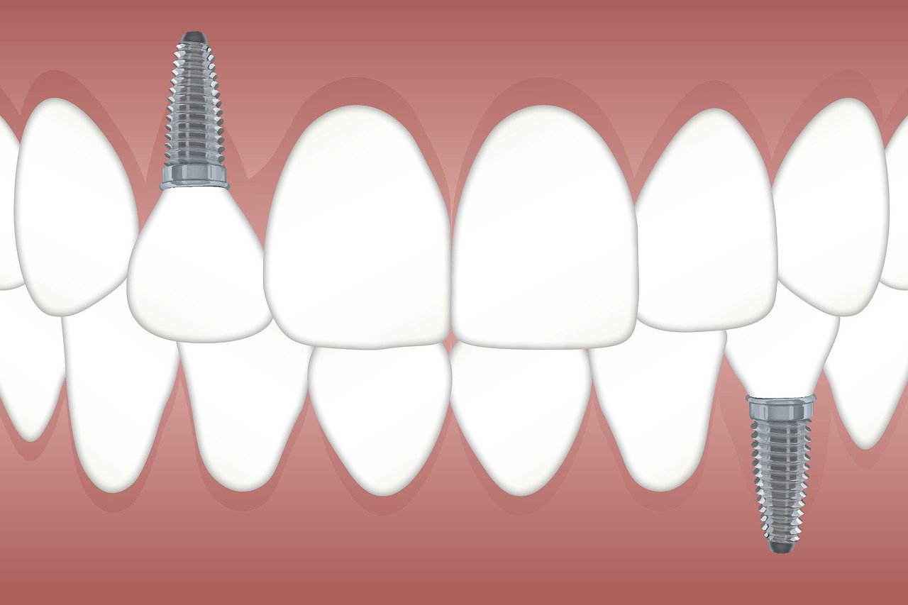 Using All-on-Six Dental Implants for Full-Arch Restoration