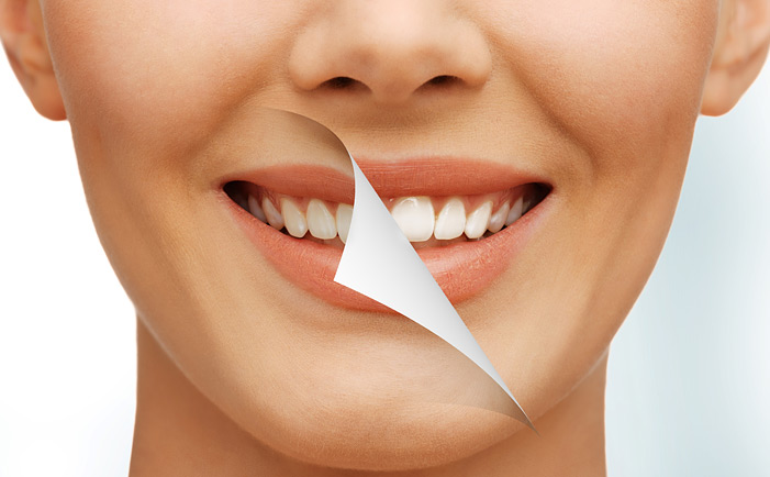 At-home vs. Professional Teeth Whitening