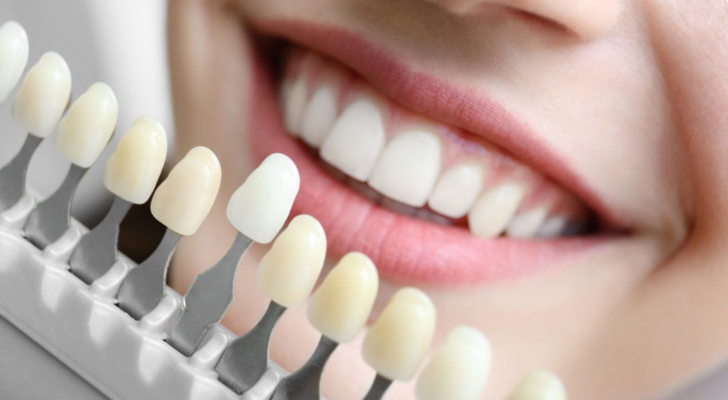 Composite Veneers: Pros, Cons and Features of the Procedure