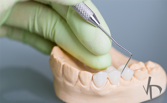 Dental Crowning Procedure