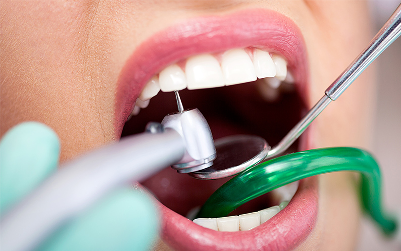 dental filling