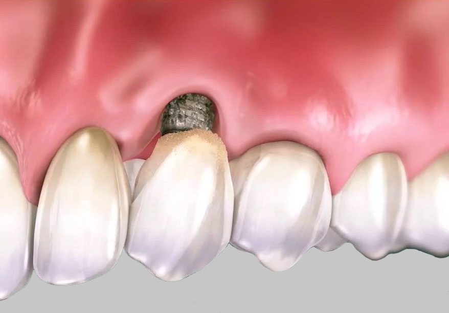 Why Some Dental Implants Fail? Dental Implant Rejection Symptoms