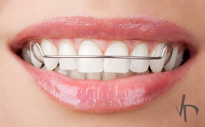 Dental Plates as an Alternative to Braces