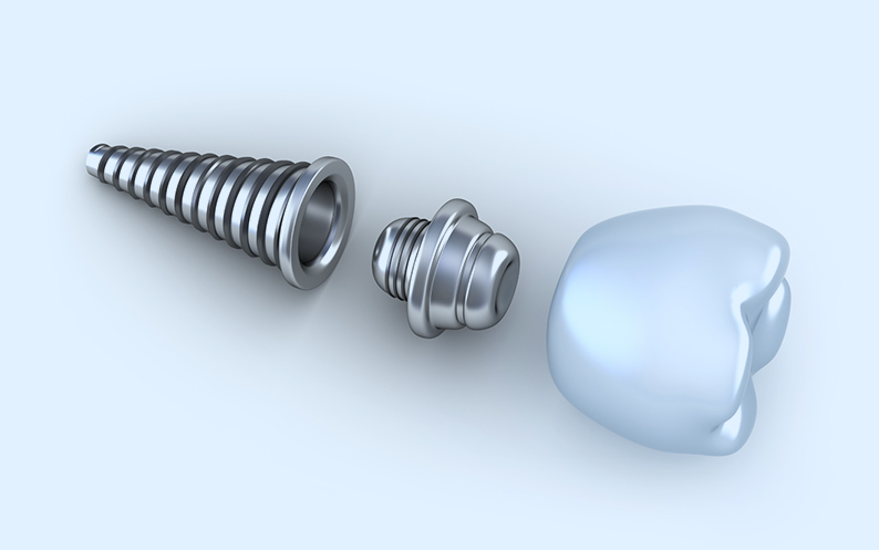 Tooth Implant tooth implant nyc