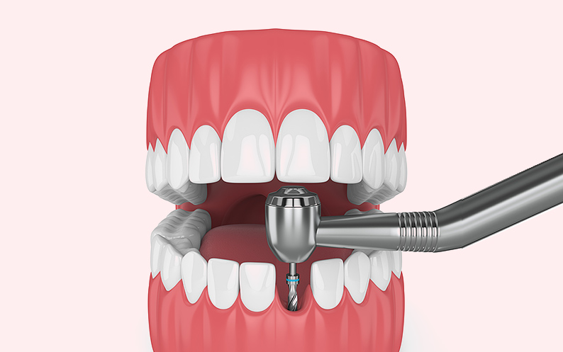 Dental Implant in the Gum denture implants nyc