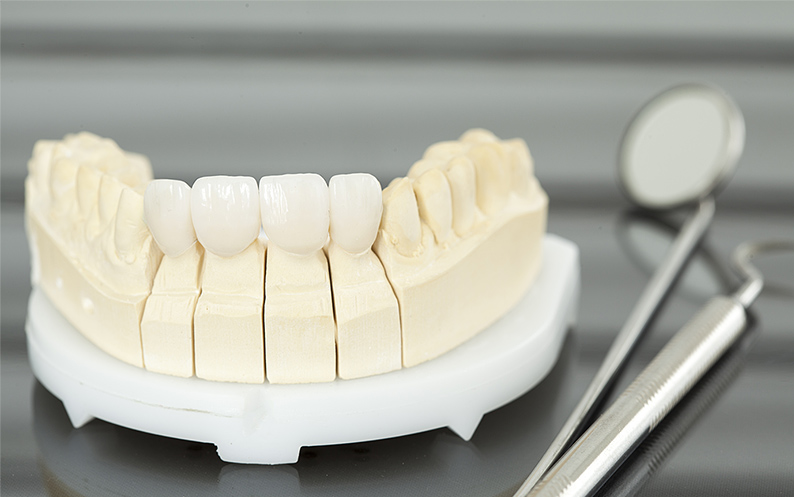 Porcelain Veneers making veneers
