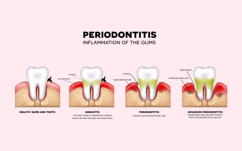 Gum Disease types of gum disease