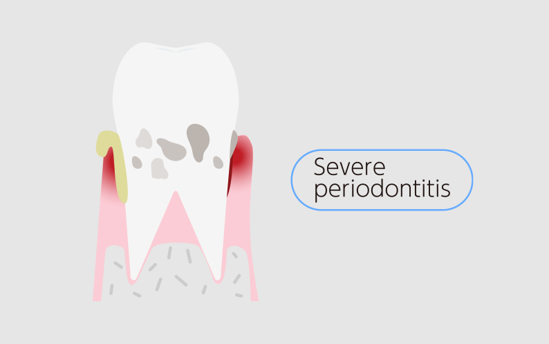 Severe Periodontitis severe periodontitis treatment