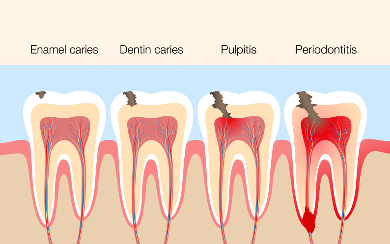 Stages of Periodontitis periodontitis causes