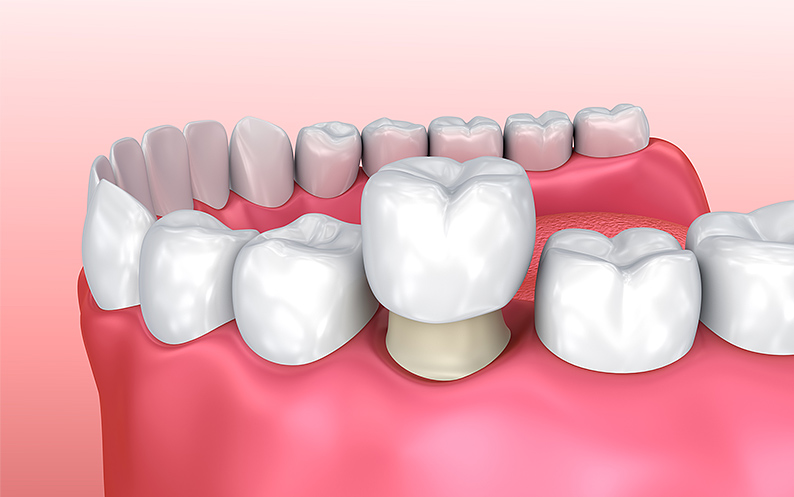 Crowns Porcelain crowns pocelain nyc