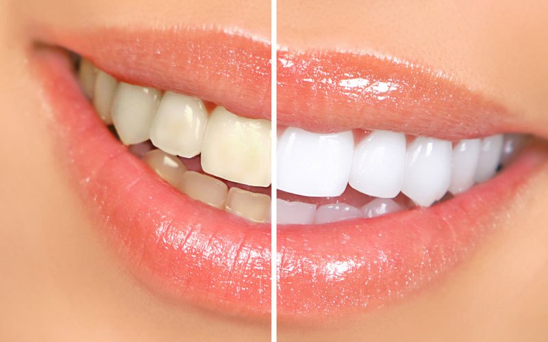 After Teeth Whitening Procedure teeth whitening nyc