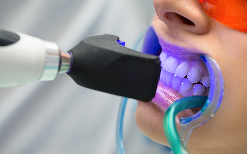 Ultraviolet Teeth Whitening ultraviolet teeth whitening