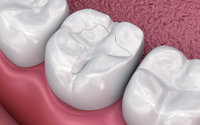 after cavity filling