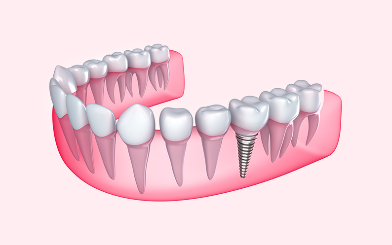 Dental Implant dental implant nyc