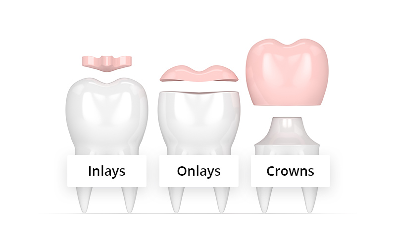 Difference Between Inlays, Onlays and Crowns inlays onlays crowns difference