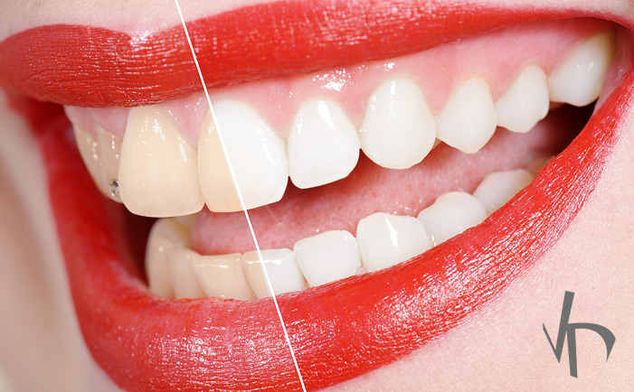 Learning More About Tooth Discoloration