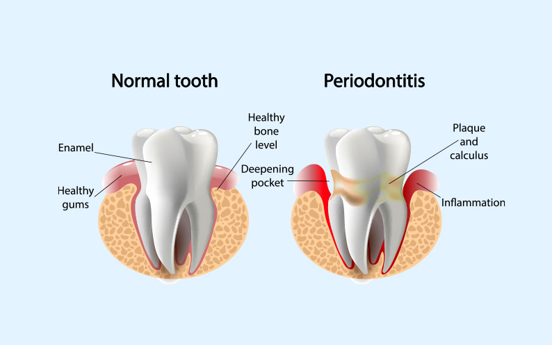 Periodontitis periodontitis treatment