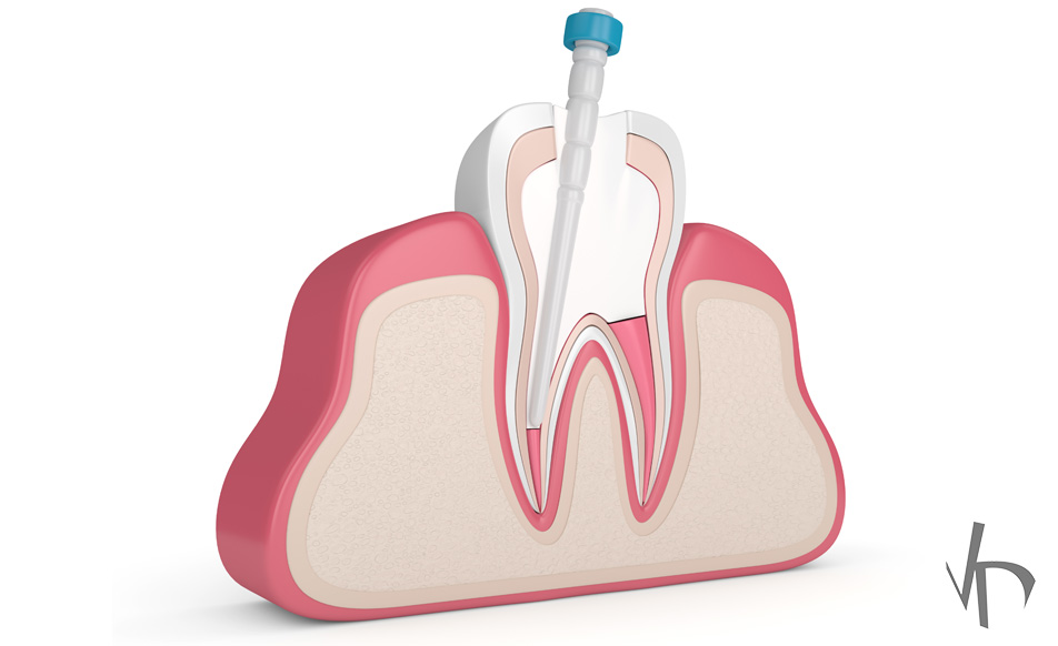 Tooth Core Build Up: Procedure Features and Advantages