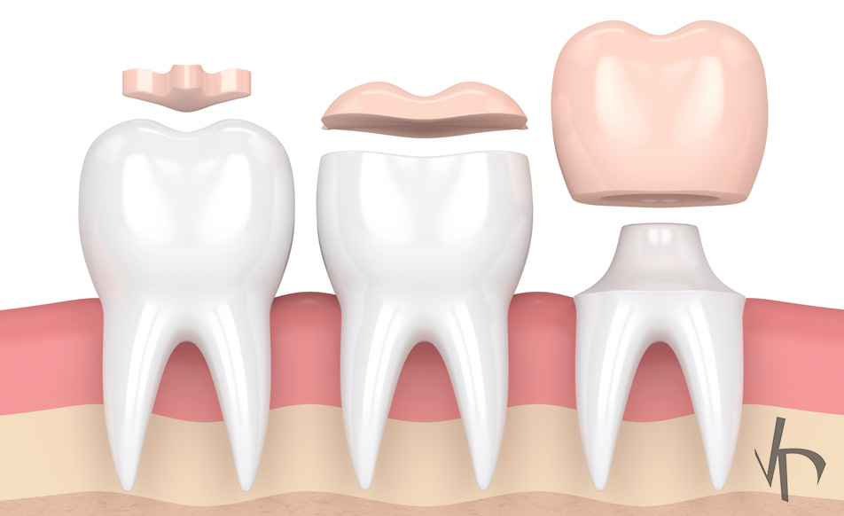 Types of Teeth Inlays and Onlays